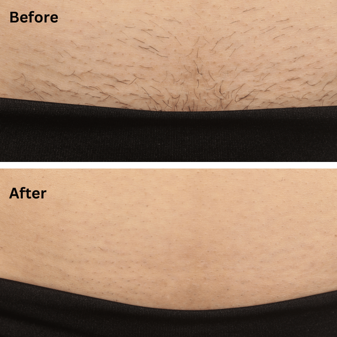 Before and After