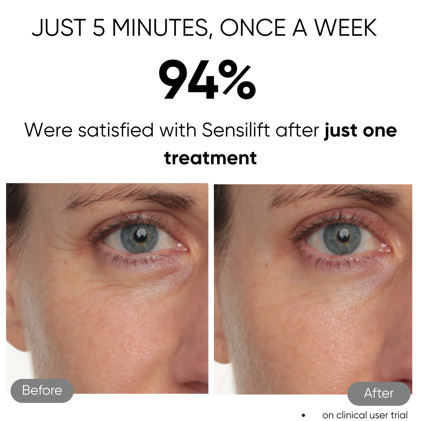 Sensilift Before & After