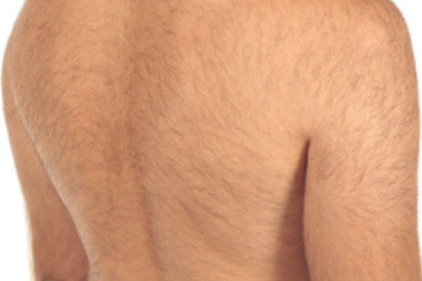 Shoulders & Back - hair removal results — Before