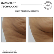 Sensifirm Anti-Cellulite Skin Tightening