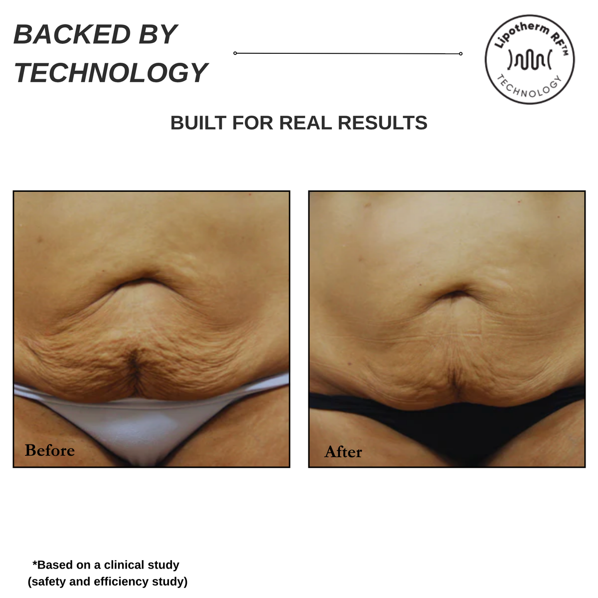 Sensifirm Anti-Cellulite Skin Tightening