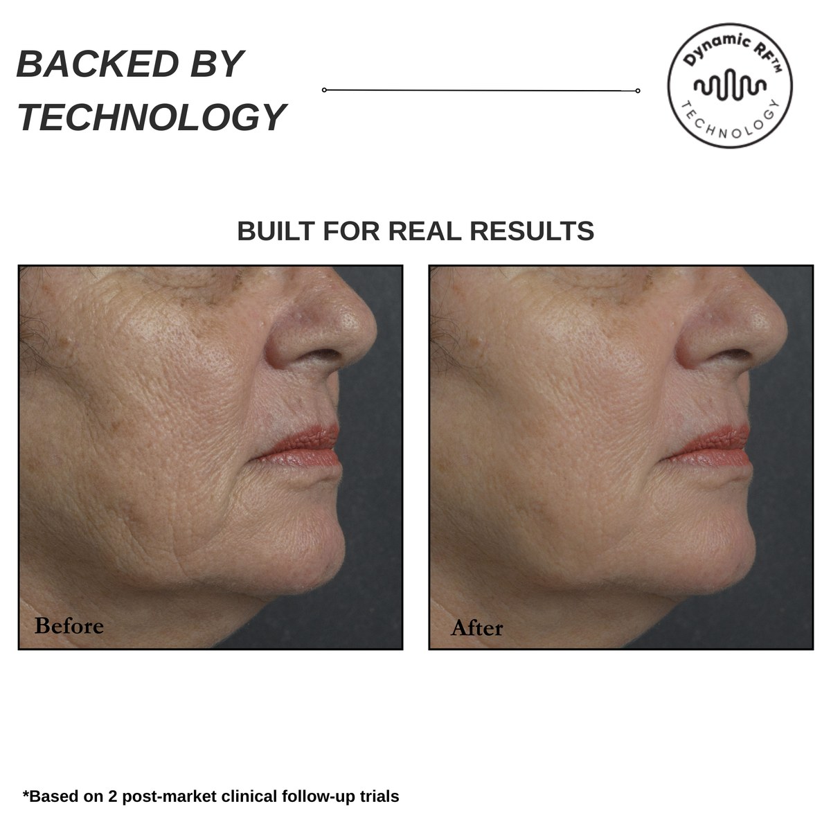 Sensilift At-Home Skin-Firming