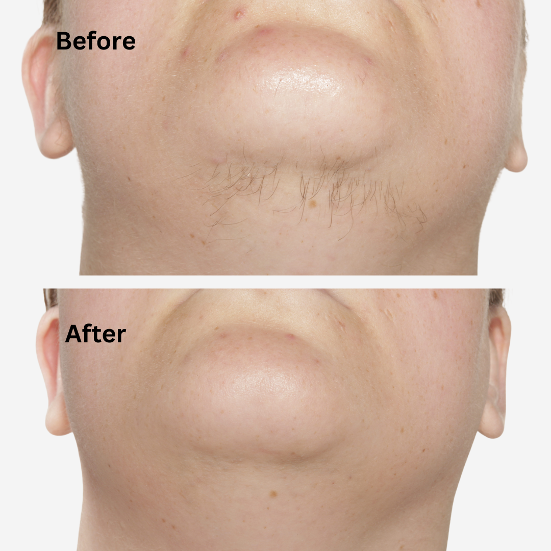 Bafore and After
