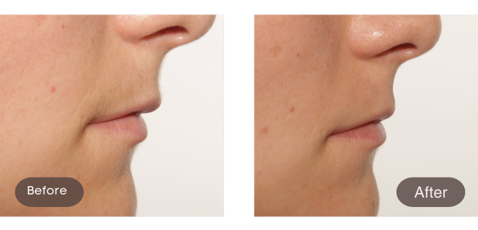 Before and after comparison